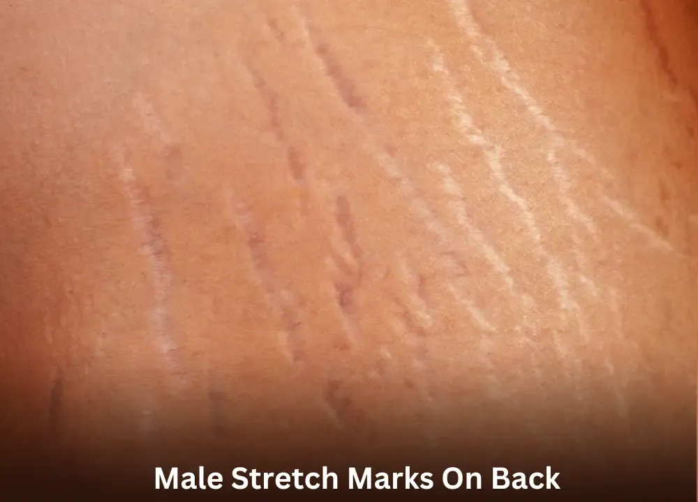 Understanding Male Stretch Marks on Back Causes and Solutions