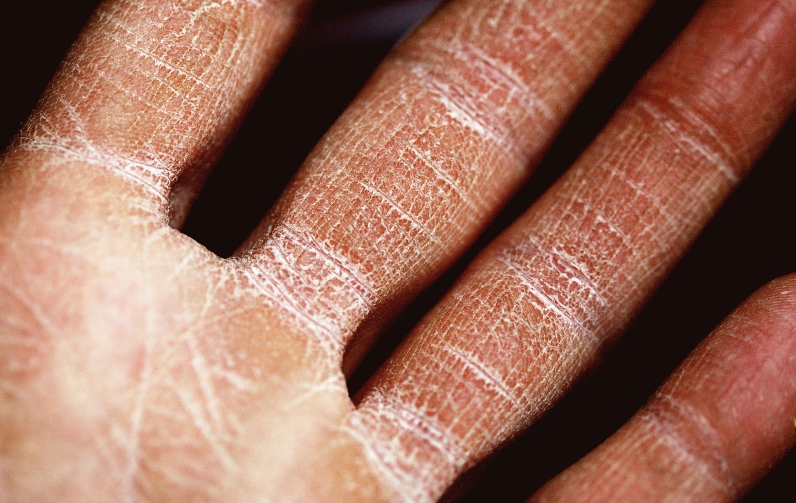 How To Get Rid Of Calluses On Hands From Lifting Weights?